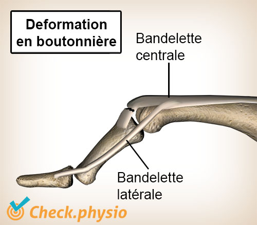 doigt déformation boutonnière tendon extenseur bandelette latérale bandelette centrale