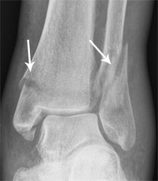 pied fracture de la cheville radiographie