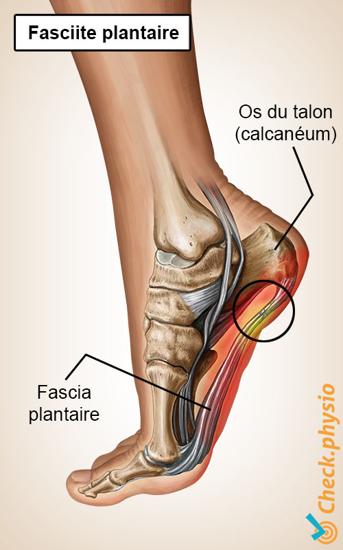 pied fasciite plantaire aponévrose épine calcanéenne