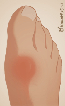 photo hallux rigidus du pied