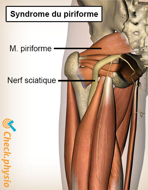 fesse syndrome piriforme anatomie