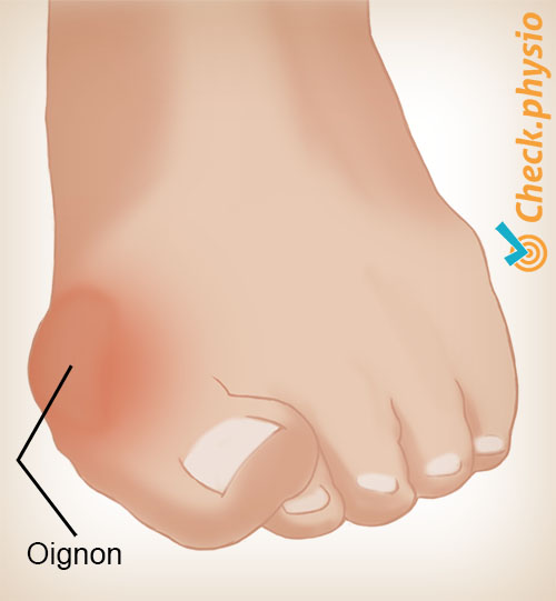 pied hallux valgus oignon