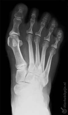 pied hallux valgus radiographie