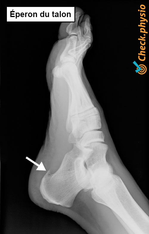 pied épine calcanéenne radiographie
