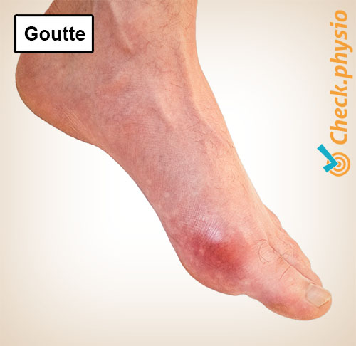 pied goutte orteil rouge gonflement tophus
