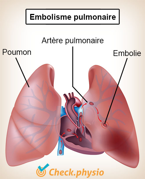 poitrine poumons embolie pulmonaire cœur artère pulmonaire
