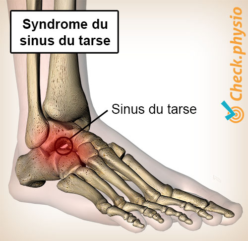 pied syndrome du sinus du tarse tunnel
