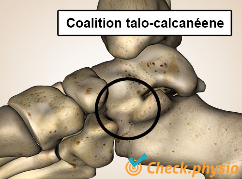 pied coalition talocalcanéenne