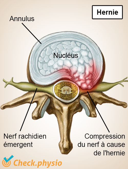 colonne vertébrale vertèbre disque intervertébral hernie nerfs