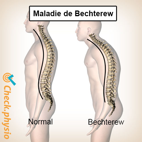 maladie de Bechterew cyphose dos voûté
