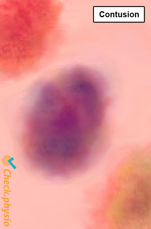 contusion ecchymose couleur bleu rouge jaune