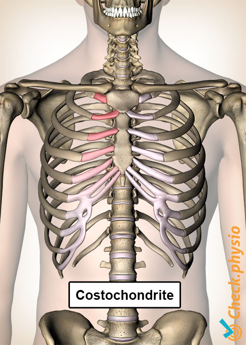 costochondrite côtes douleur poitrine sternum