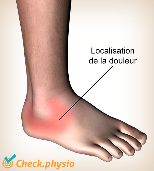 cheville lésion ligament externe douleur localisation traumatisme latéral par inversion