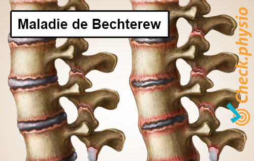 dos douleur lombaire spécifique maladie de Bechterew spondylarthrite ankylosante