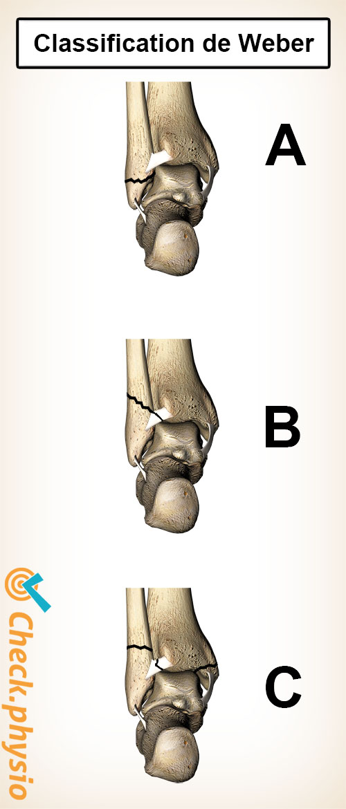 fracture de la cheville classification de Weber a b c
