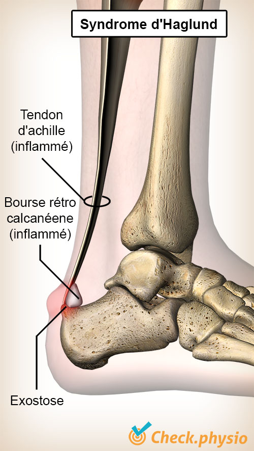 cheville syndrome de Haglund tendon d'Achille bourse rétrocalcanéenne os du talon calcanéum