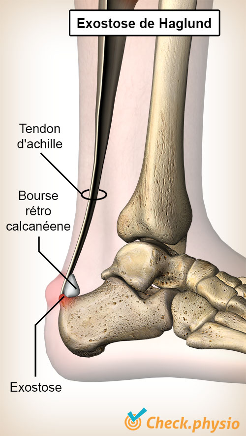 cheville exostose de Haglund déformation tendon d'Achille bourse rétrocalcanéenne os du talon calcanéum