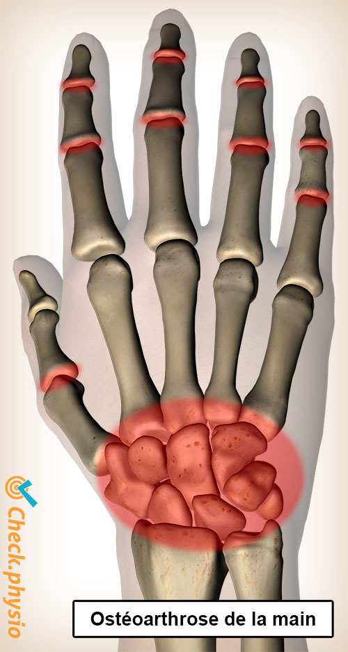 main arthrose localisation des douleurs