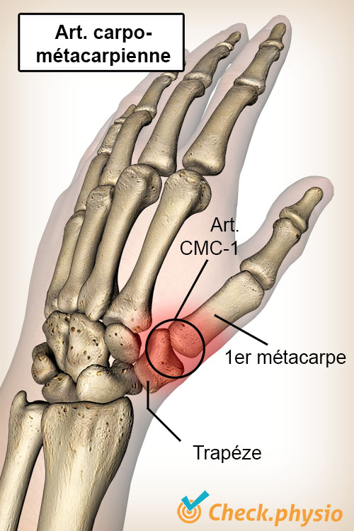 main pouce arthrose base du pouce os trapèze premier métacarpien articulation CMC 1
