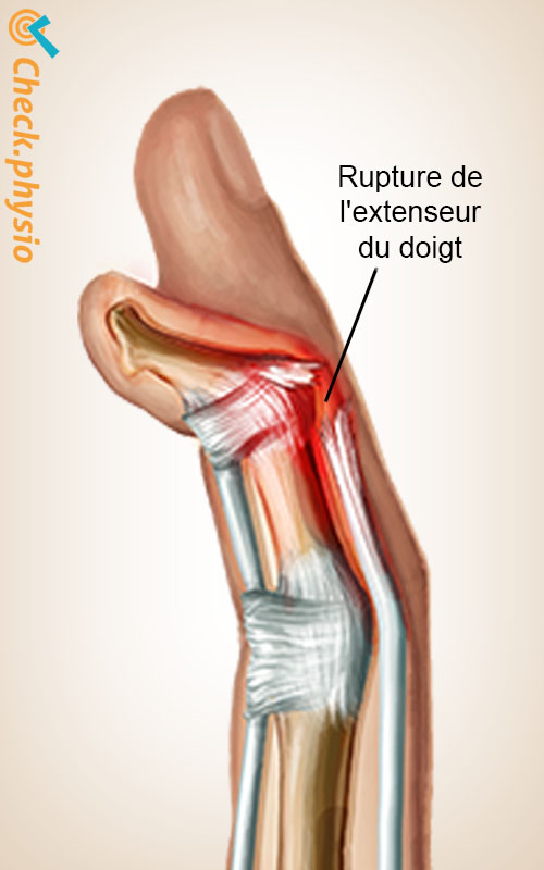 main doigt en maillet anatomie