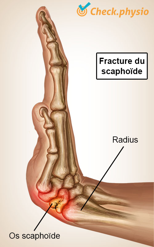 main fracture du scaphoïde