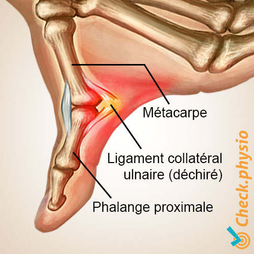 main pouce du skieur anatomie ligament collatéral ulnaire