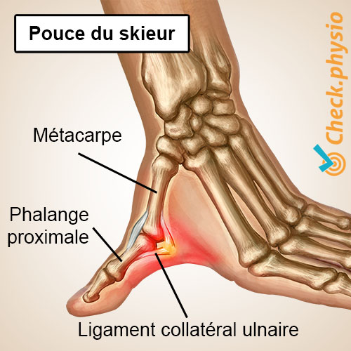 main pouce du skieur