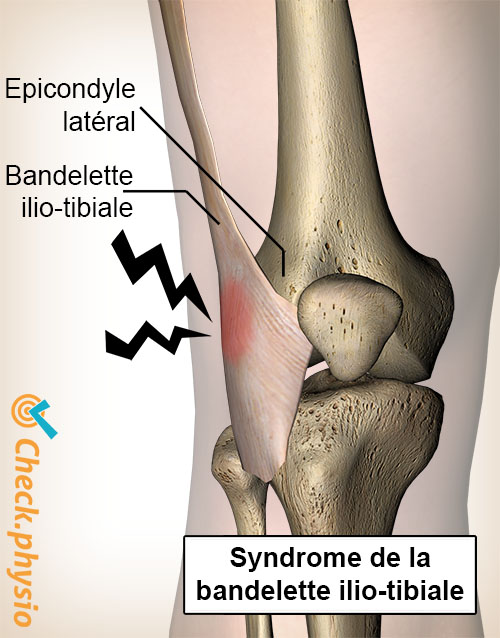 syndrome de la bandelette ilio-tibiale du genou épicondyle latéral