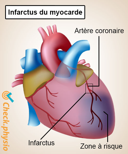 cœur infarctus artère coronaire anatomie