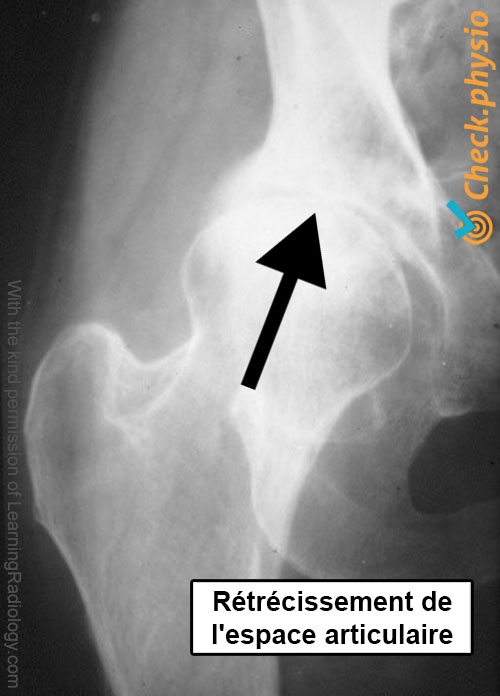 arthrose hanche radiographie interligne articulaire