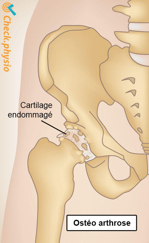 arthrose de la hanche