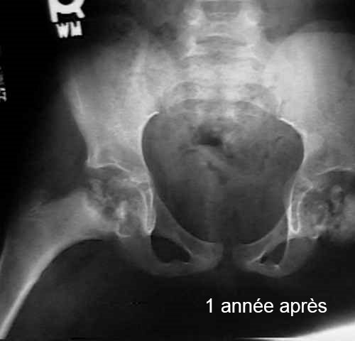 hanche Calvé-Legg-Perthes âge 7