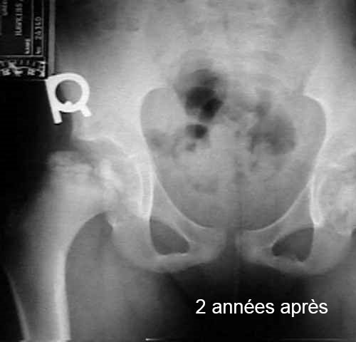 hanche Calvé-Legg-Perthes âge 8