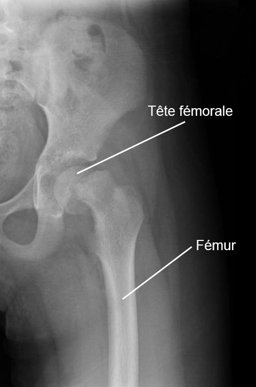 hanche épiphysiolyse de la tête fémorale radiographie