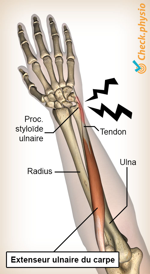 bras avant-bras extensor carpi ulnaris tendinite tendinopathie