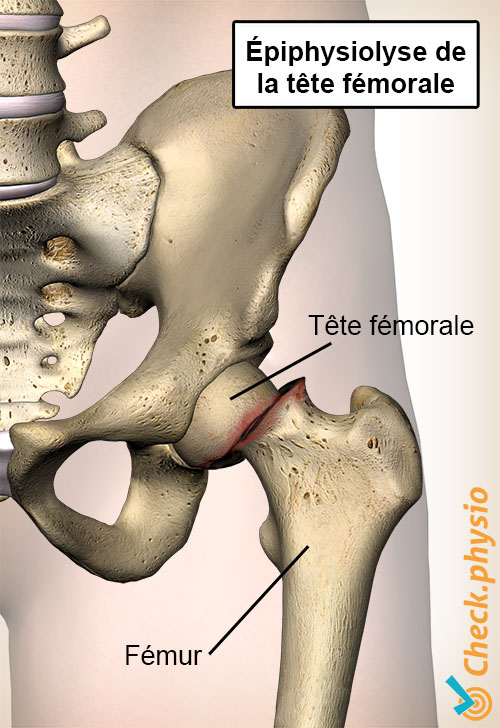 hanche épiphysiolyse de la tête fémorale