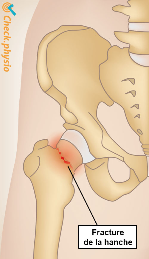 hanche fracture de la hanche anatomie