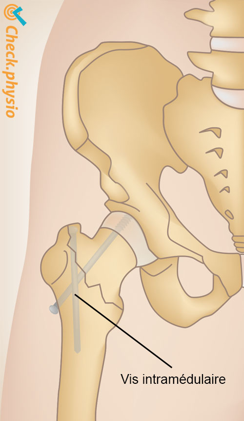 hanche fracture hanche clou gamma