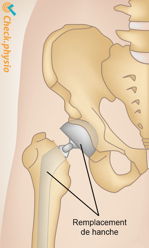 hanche fracture de la hanche prothèse